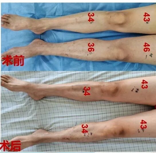 齐鲁二院血管外科成功救治急性髂静脉血栓患者