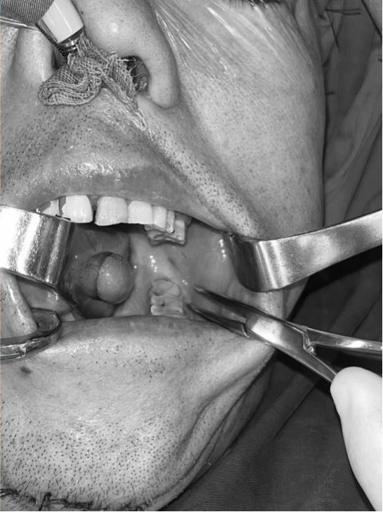 刀从口入，面部无痕——齐鲁二院完成高难度颌骨手术