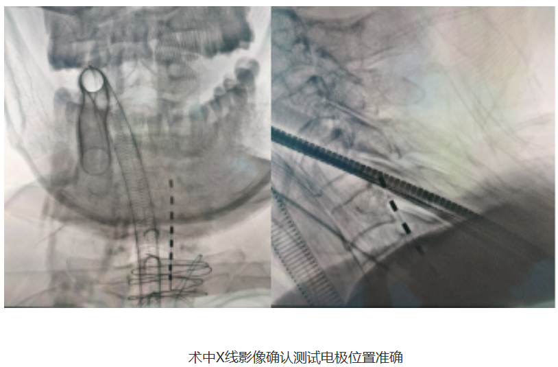 跨越千里的信任丨齐鲁二院脊髓电刺激治疗 为生命“调频”
