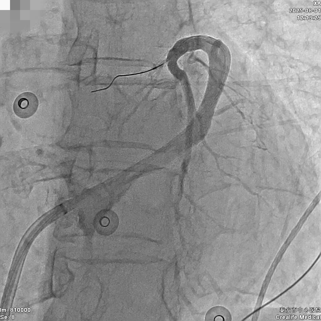 【医疗满意在人民】技术融合破“心”障 精准消融焕新生——泰安市中心医院完成全市首例心外膜室早创新治疗术