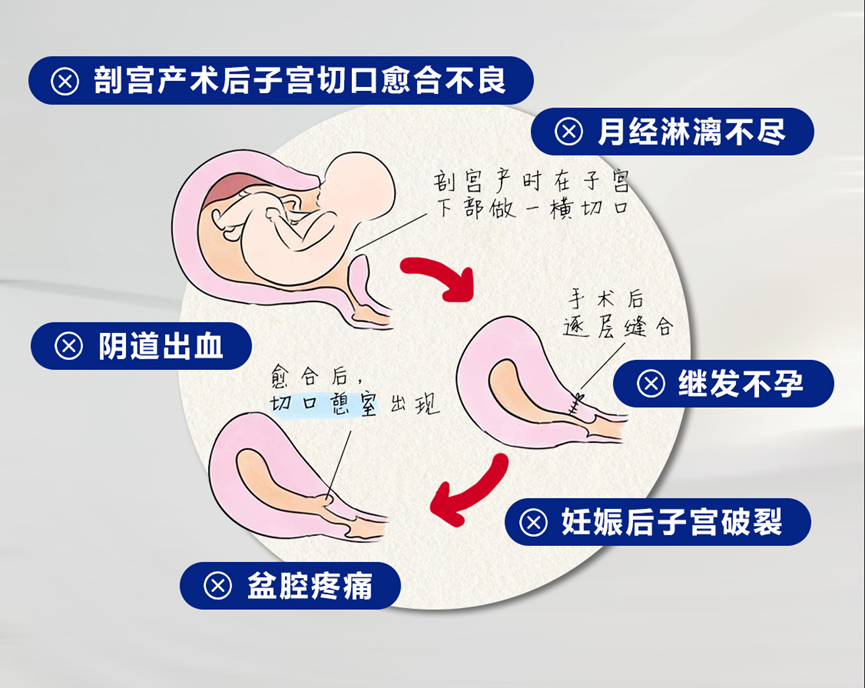 子宫憩室患者迎曙光 济南嘉乐生殖医院微创手术重塑生育“土壤”
