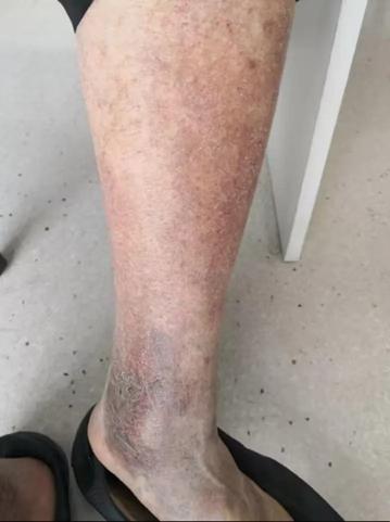 天冷就犯病，七旬大伯痒到睡不着！很多老年人都有，医生实用建议来了