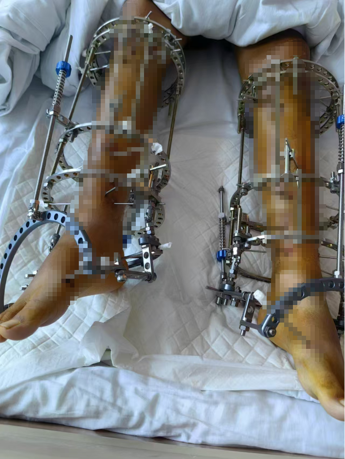 “断骨增高术”后的他们：难修复的长短腿、疼痛无力等后遗症，以及无尽的后悔