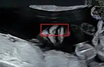 产检一切正常，孩子出生后却畸形？官方通报