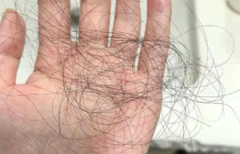 哪种体质更易脱发？中医推荐对症“养发方”