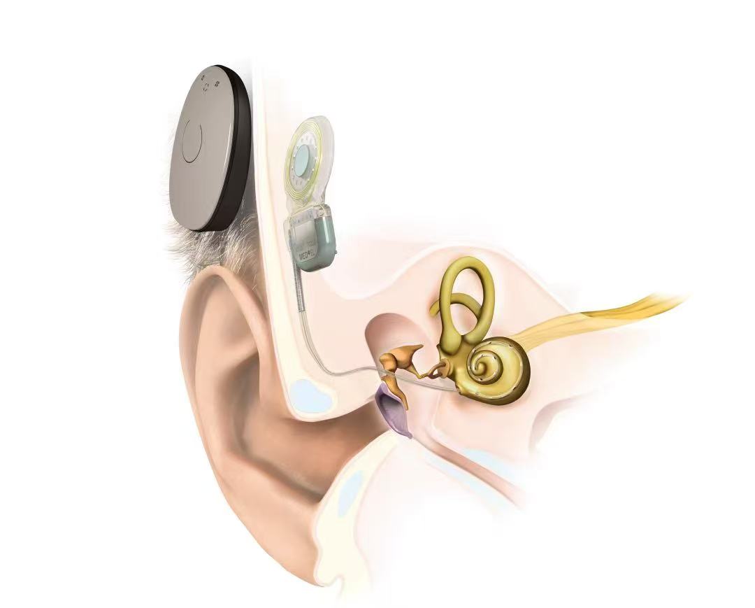 新的一年想“听得更清”？现在正是人工耳蜗咨询的好时机