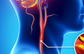 低温天气如何护住心血管？