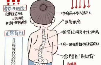 2026年临沂市康复医院脊柱侧弯寒假训练营启动招募啦