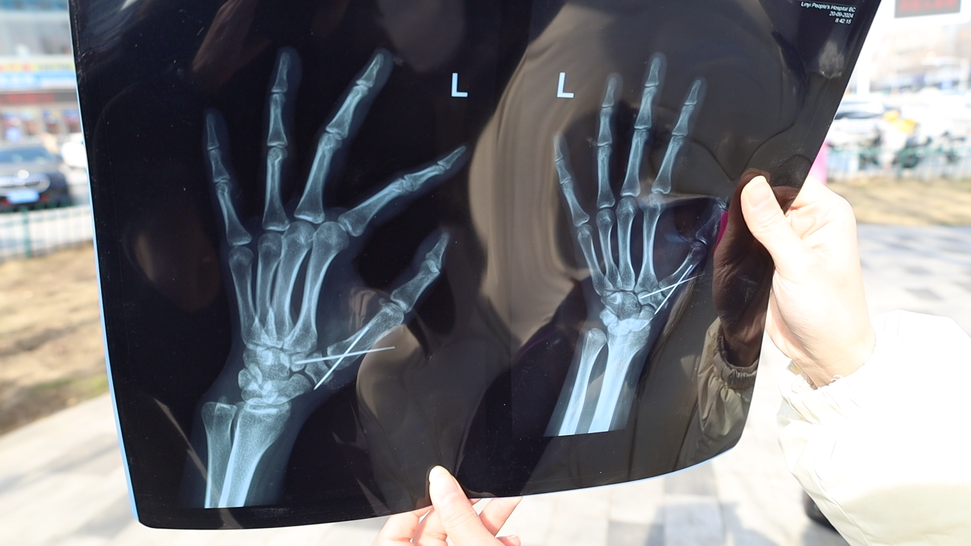 壹点帮办|临沂一市民工伤应获赔13万，企业变更法人导致追款难