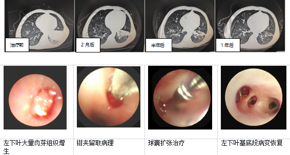 14个月坚守，济南市儿童医院助力宁夏肺不张患儿重燃希望 