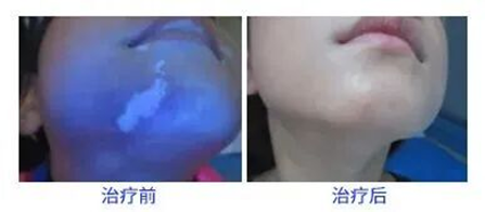 白癜风公益援助启动：特邀儿童专家邢嬛教授2月21日会诊