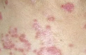 专家：过度劳累、免疫力下降者易被带状疱疹“盯上”