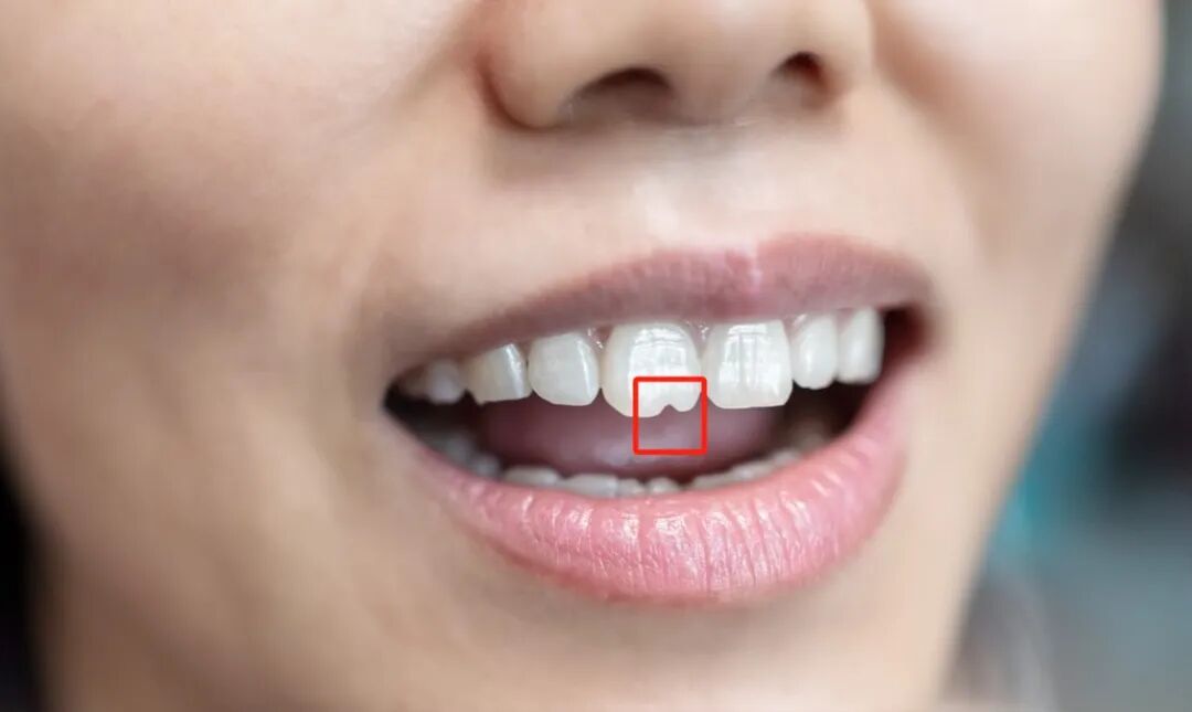 门牙前的“豁”真是嗑瓜子惹的祸？多年来的困惑终于解开了！