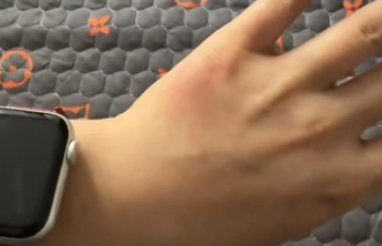 女子称坐火车硬卧遭虫咬左手肿如馒头，被诊断为丘疹性荨麻疹，12306回应