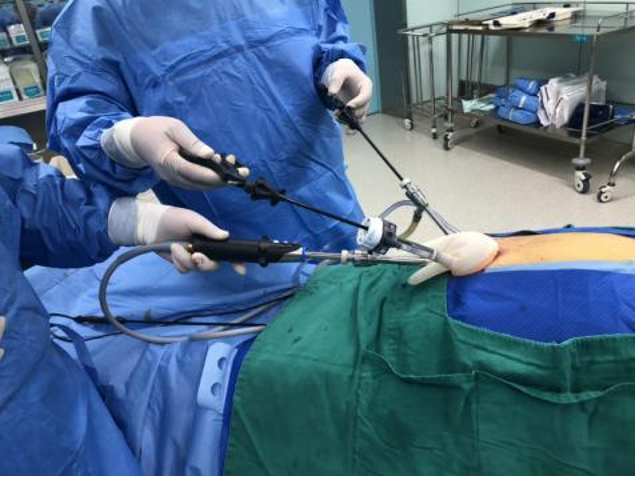 多孔变单孔康复更轻松！滨医附院经脐单孔腹腔镜肝胆胰手术再升级