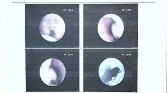 滨州市中医医院耳鼻喉科成功治疗难治性扁桃体腺样体肥大患儿