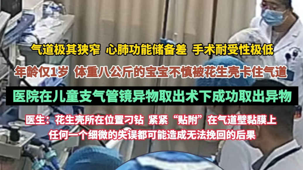 果然视频|1岁8公斤患儿花生壳卡气管，医院精准取出化险为夷