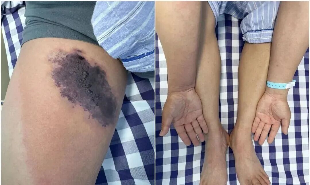 或能致命！浙江男子穿旧牛仔裤被蜘蛛咬伤中毒，医生提醒