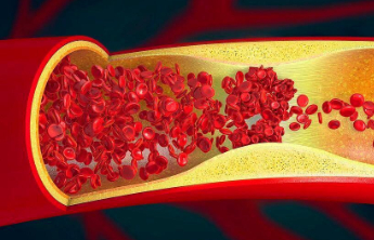男子抽出“牛奶血”！医生紧急提醒，血脂升高要注意这些身体信号