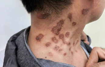 男子网购“神膏”涂抹去疣结果皮肤发红像溃烂，医生提醒别盲目用药