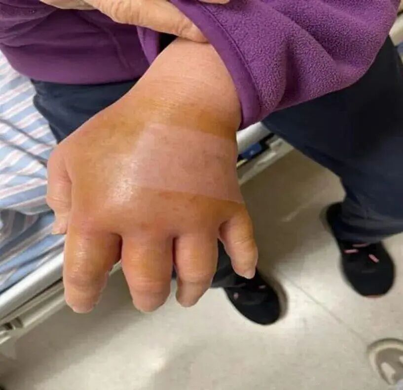 可能诱发致命感染！这种伤口要小心