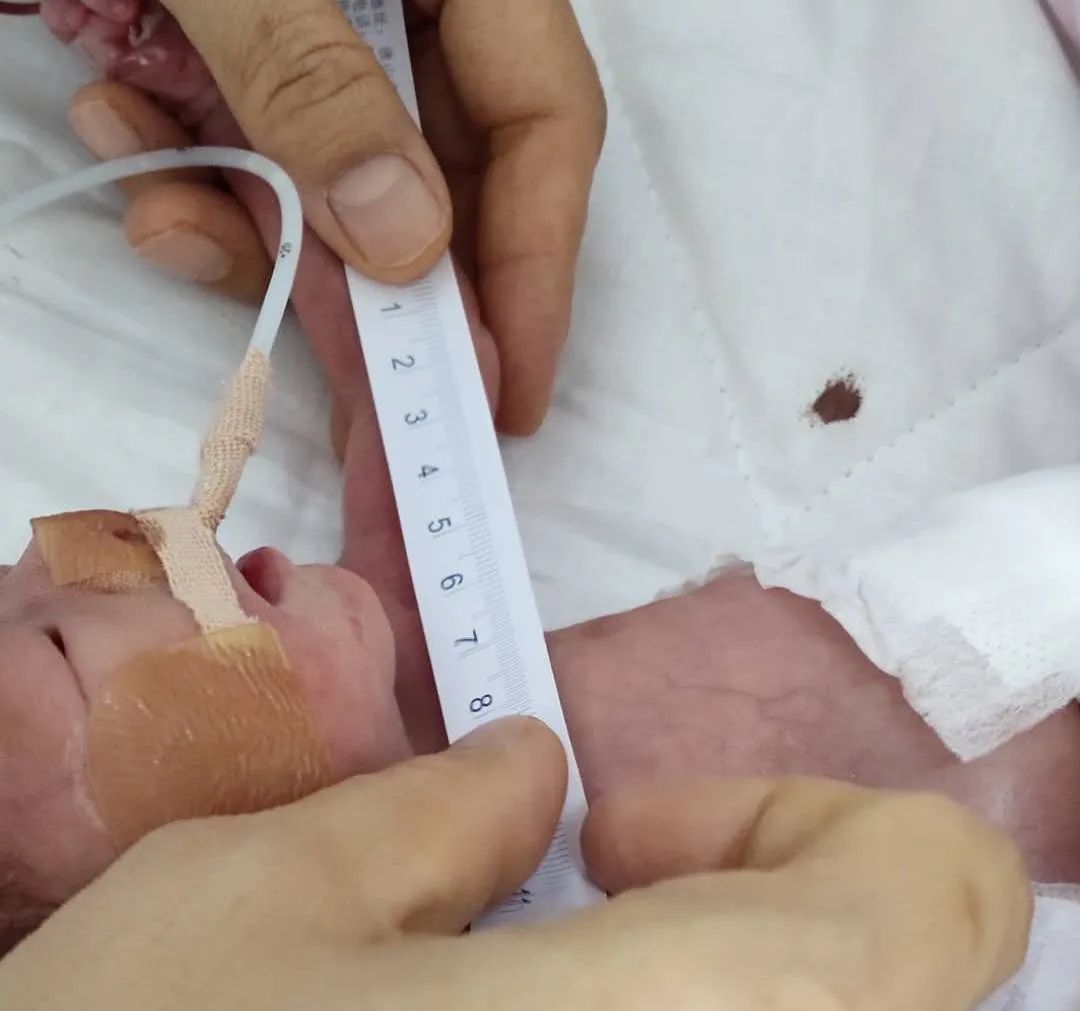 拯救袖珍宝宝区人民医院首例早产儿picc置管成功