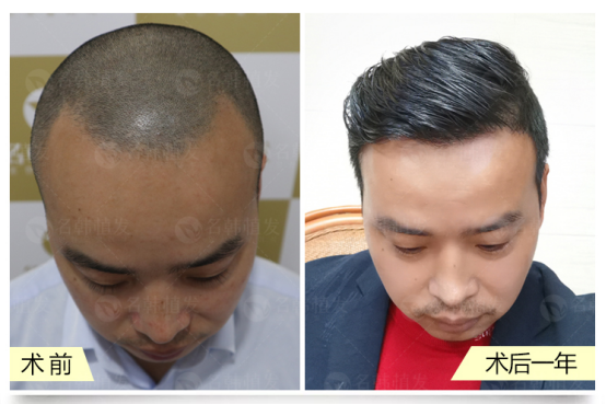 植发对比男士(植发对比男士发型图片)