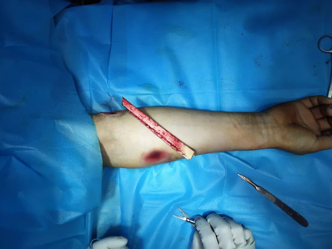 看着就疼!菏泽一女子被木条刺穿右臂,两个多小时手术后.