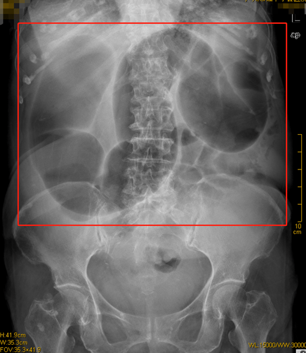 肠梗阻x线报告单图片
