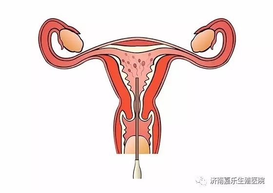 宫外孕b超图片 清晰图片