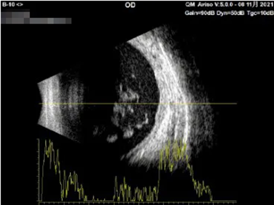 玻璃体出血超声报告图片