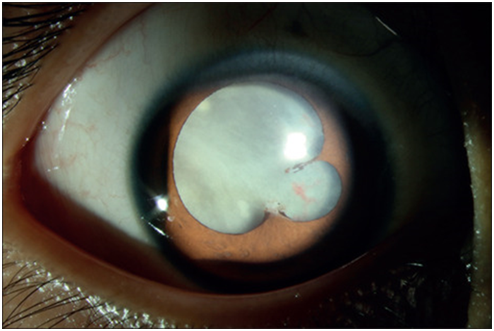 全球首例白瞳症眼弓蛔虫病病例发现 研究团队之一来自四川农业大学