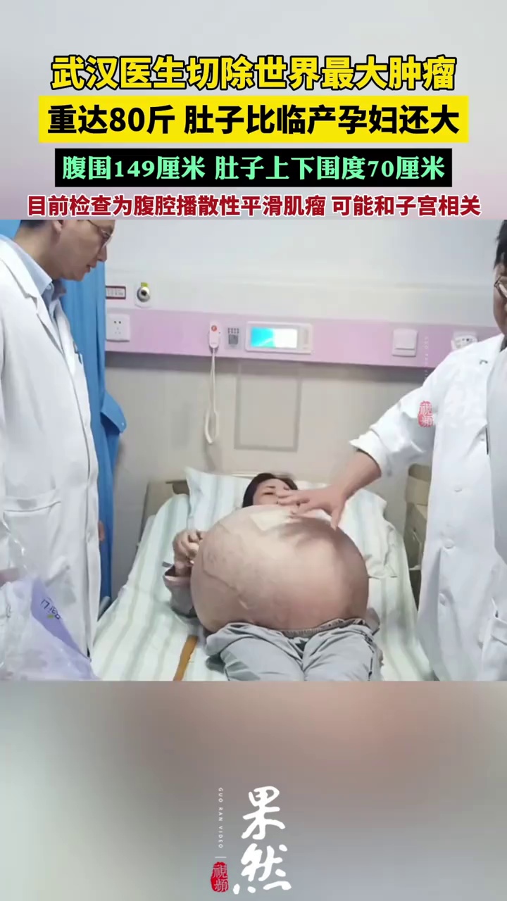 48岁女子长80斤肿瘤，肚子比临产孕妇还大！武汉医生切除世界最大肿瘤重达80斤！（武汉晚报）