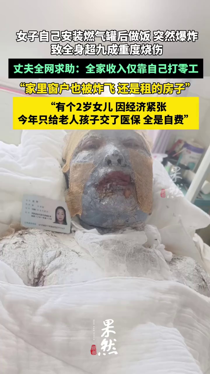 妻子遇液化气泄漏爆炸全身超九成烧伤，丈夫全网求助：不敢想象她该有多疼（极目新闻）