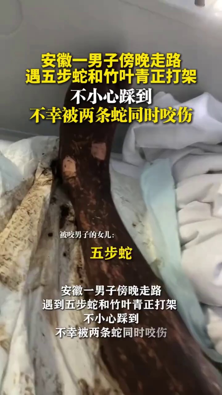 安徽一男子傍晚走路遇五步蛇和竹叶青正打架，不小心踩到，不幸被两条蛇同时咬伤