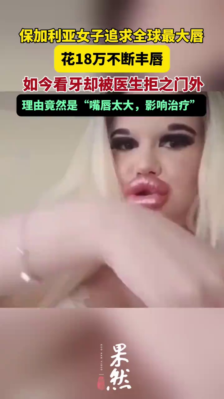 28岁女子砸18万元整形拥有“世界最大嘴唇”，如今看牙医被拒