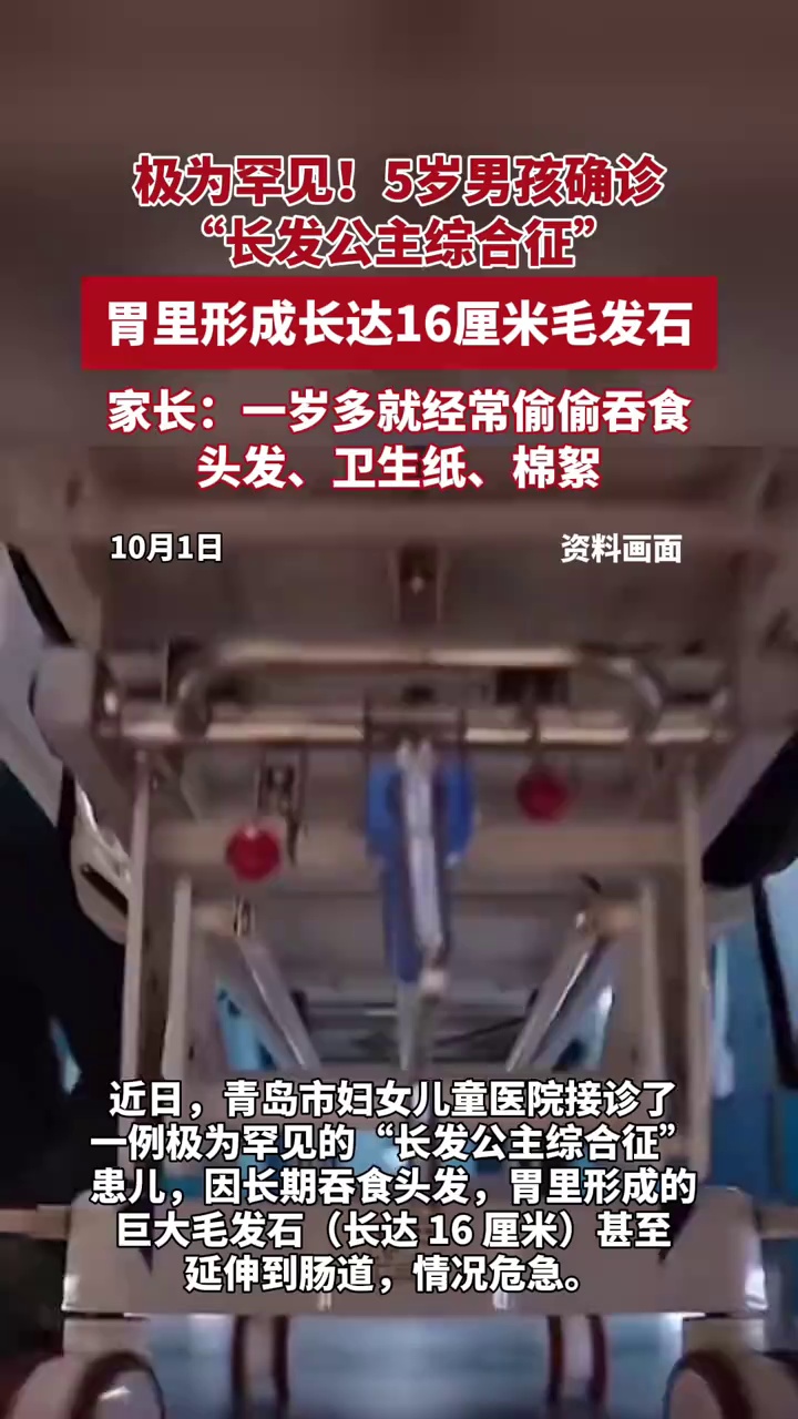 极为罕见！5岁男孩确诊“长发公主综合征”，家长：打小爱吃头发、卫生纸、棉絮
