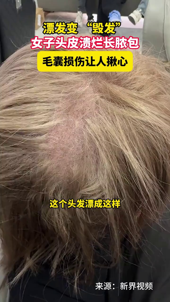 漂发变“毁发”，女子头皮溃烂长脓包，毛囊损伤让人揪心
