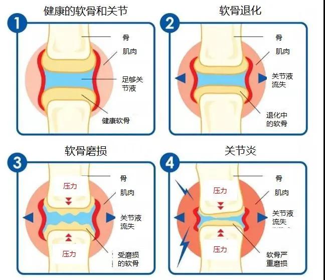 50以上的中老年人深受关节炎之苦原因究竟为何