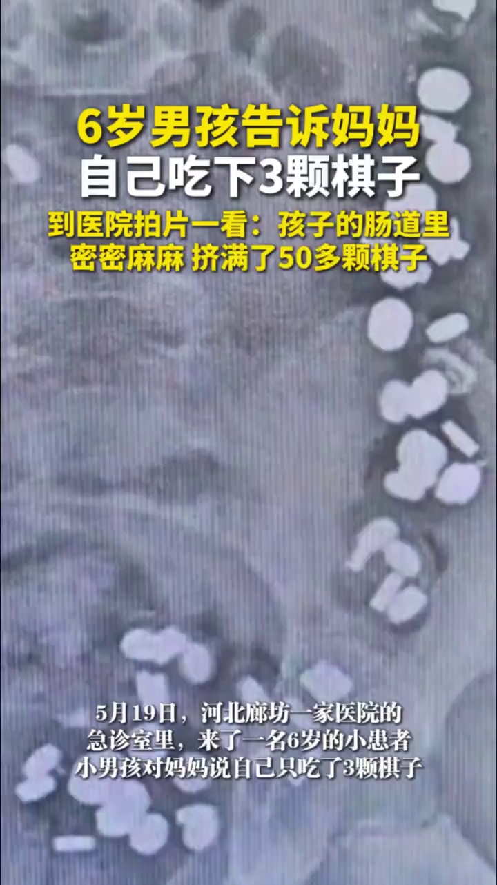 6岁男孩告诉妈妈自己吃下3颗棋子，到医院拍片一看：孩子的肠道里挤满了50多颗棋子