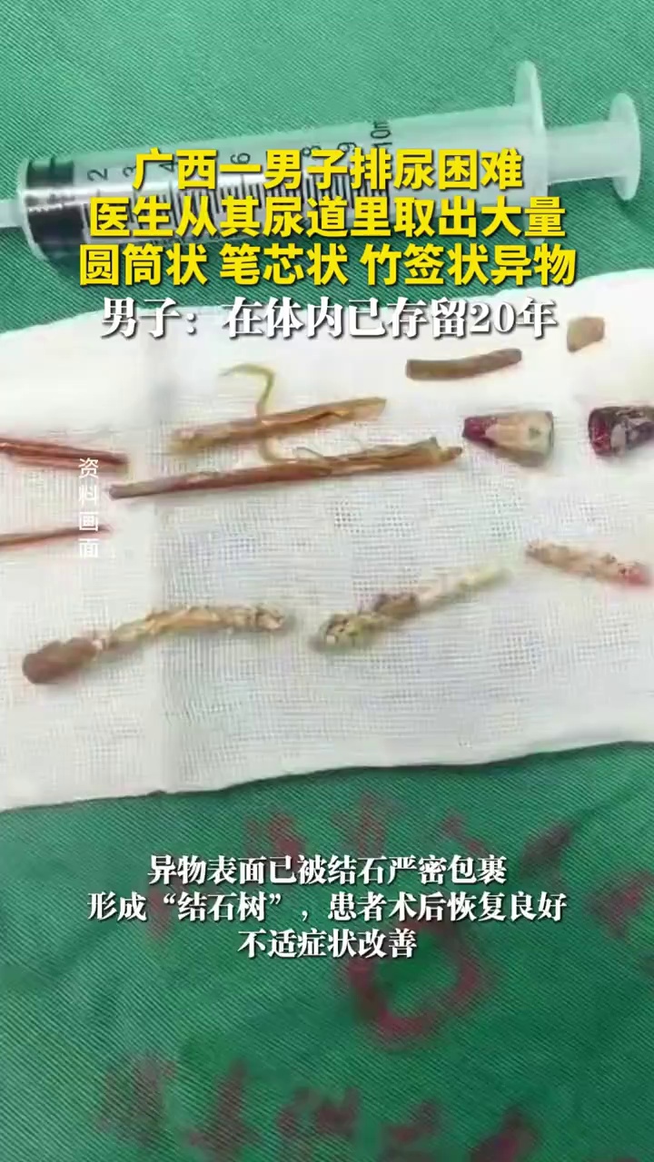 广西一男子排尿困难，医生从其尿道里取出大量圆筒状、笔芯状、竹签状异物，男子：在体内已存留20年