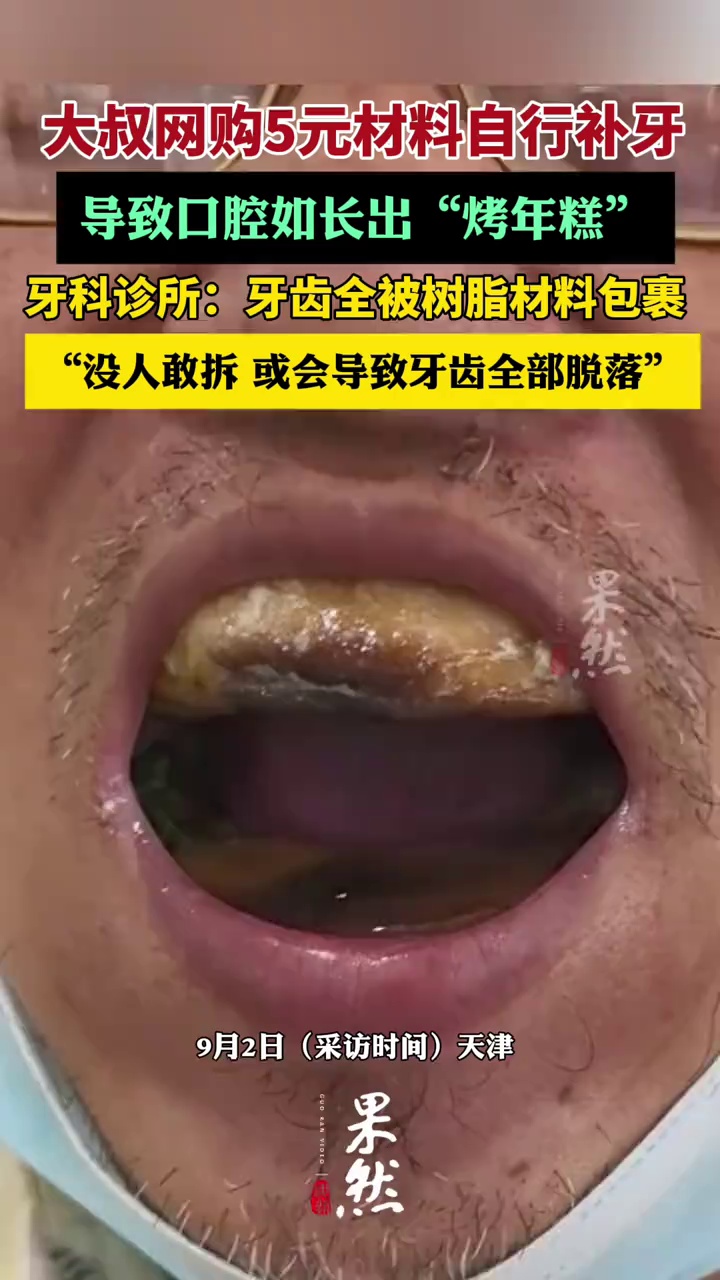 大叔网购5元材料自行补牙 致牙齿被树脂全部包裹现已无法处理（荔枝新闻）