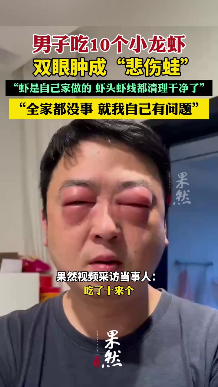 男子吃10个小龙虾，双眼肿成“悲伤蛙”
感谢@朱帅帅 接受采访