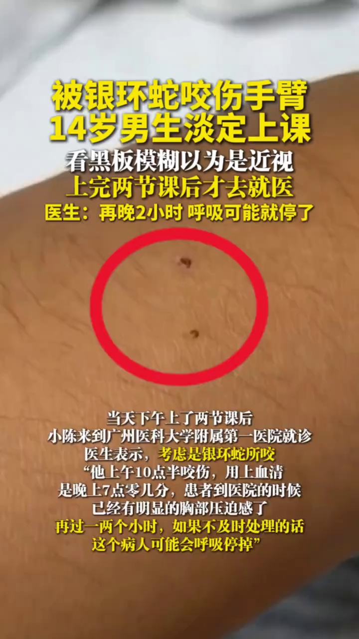 14岁男生被银环蛇咬伤手臂后淡定上课，上完两节课后才去就医，医生：再晚2小时，呼吸可能就停了