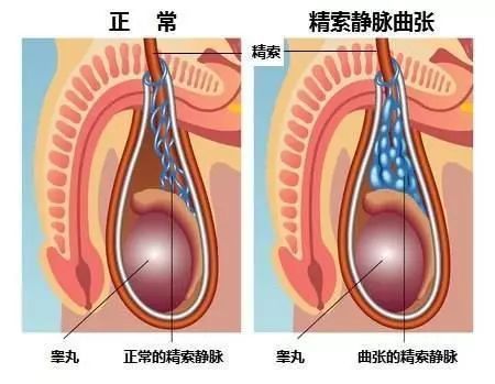 男性不育元兇之一,精索靜脈曲張!