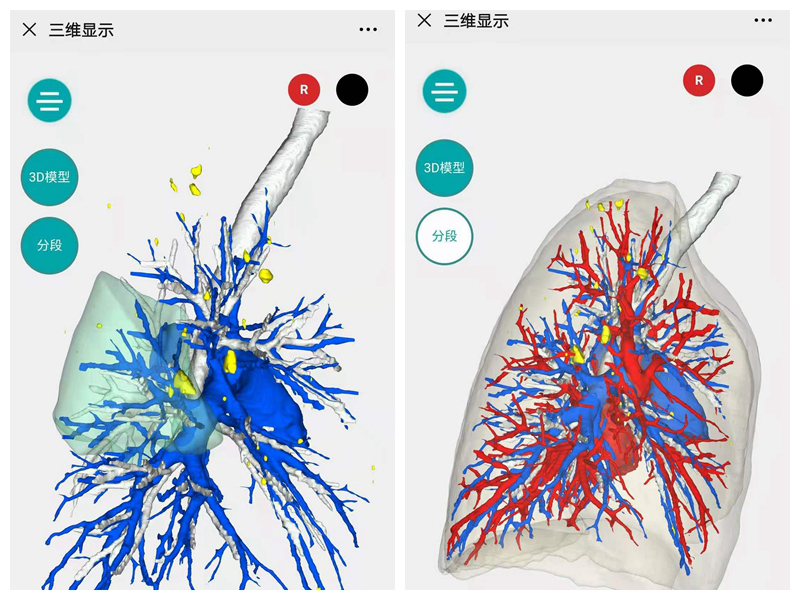 齐鲁医典借助三维重建术前规划精准切除肺结节