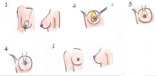 断奶后乳房下垂图片