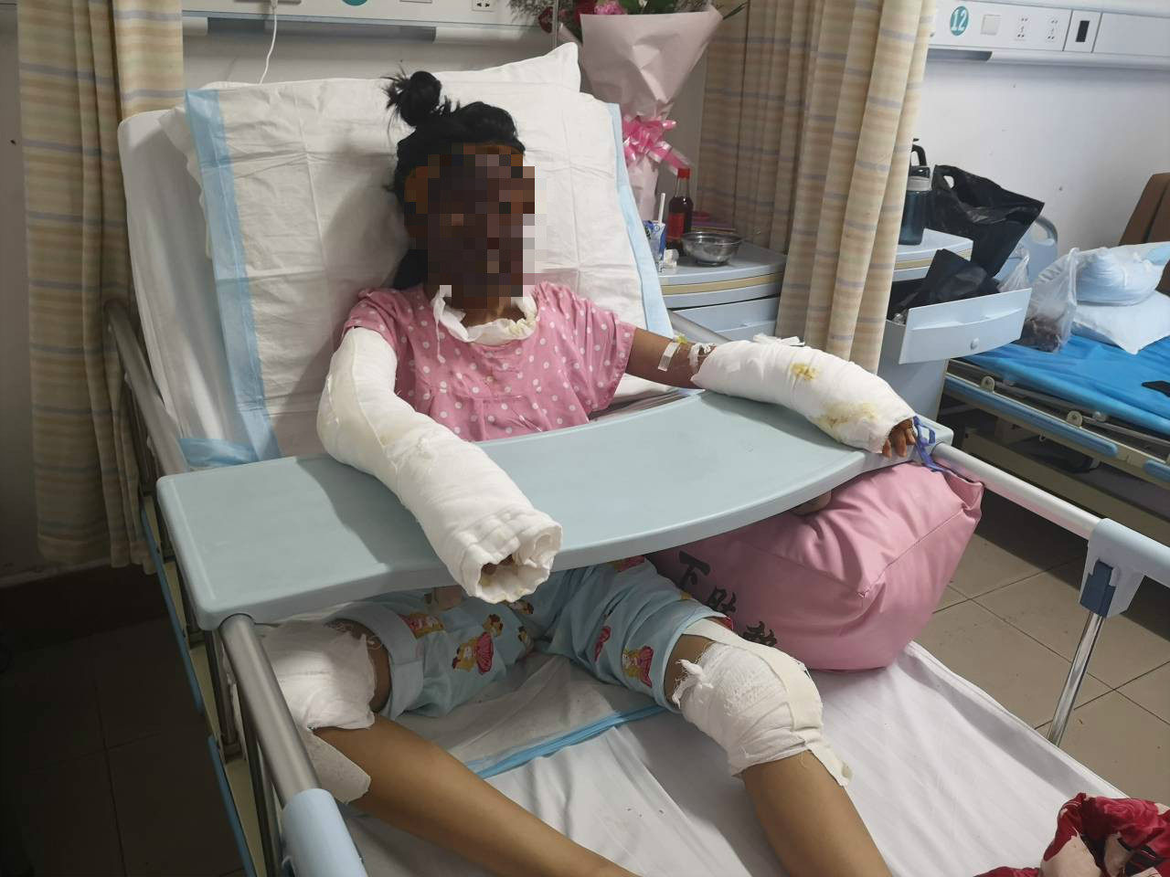 枣庄两少女模仿网络易拉罐爆米花被炸伤一女孩全身96被烧伤