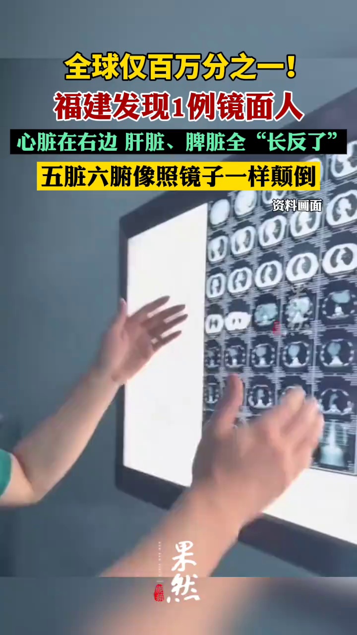 福建发现1例镜面人