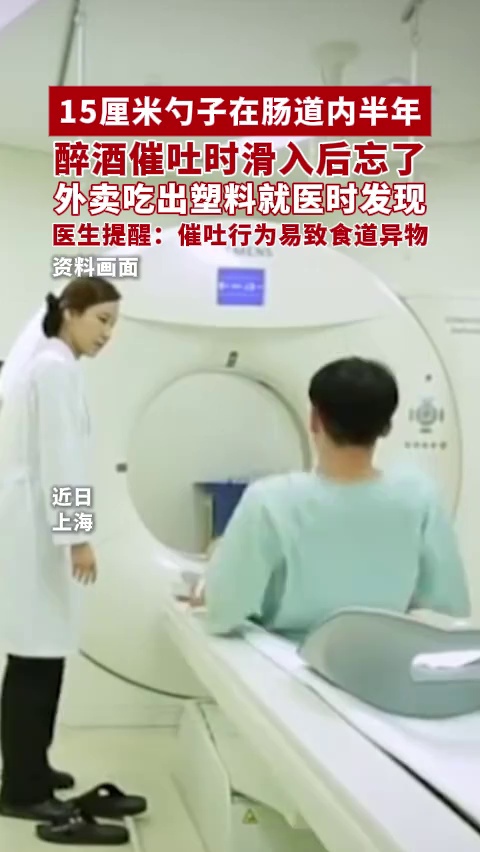 15厘米勺子在肠道内半年才被发现，竟是男子醉酒催吐时滑入然后遗忘了